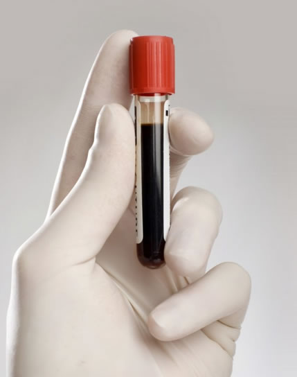 Drawn Blood Sample